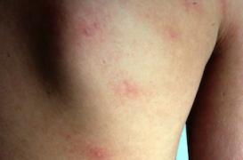 Urticaire : 20 % de la population mondiale se gratte